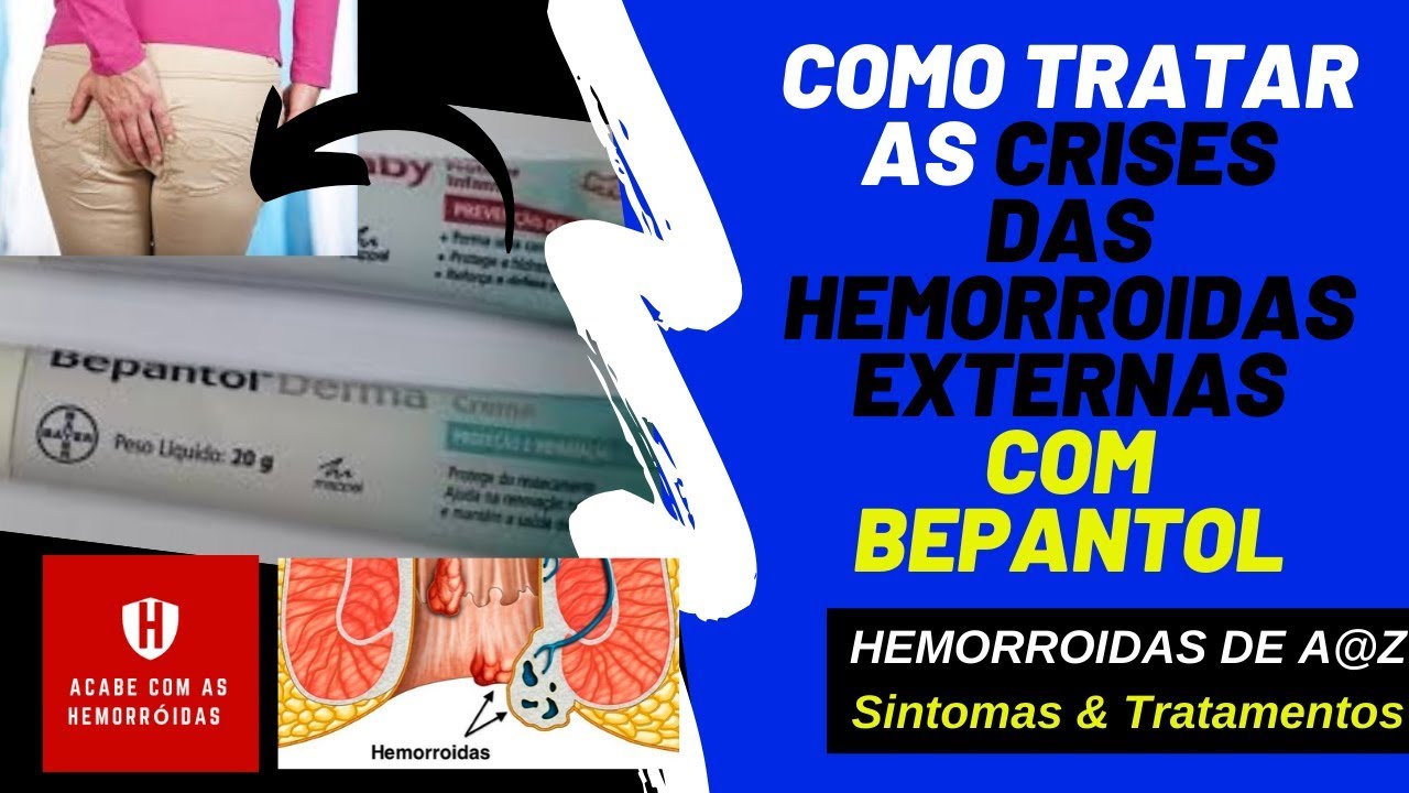 como tratar hemorroidas externas pequenas