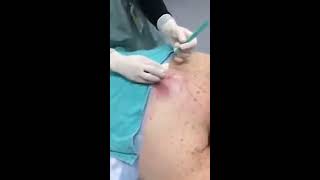 Huge Infected Cyst On Back Explodes