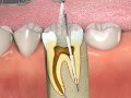 ProPoint- How to obturate a root canal with SmartSeal