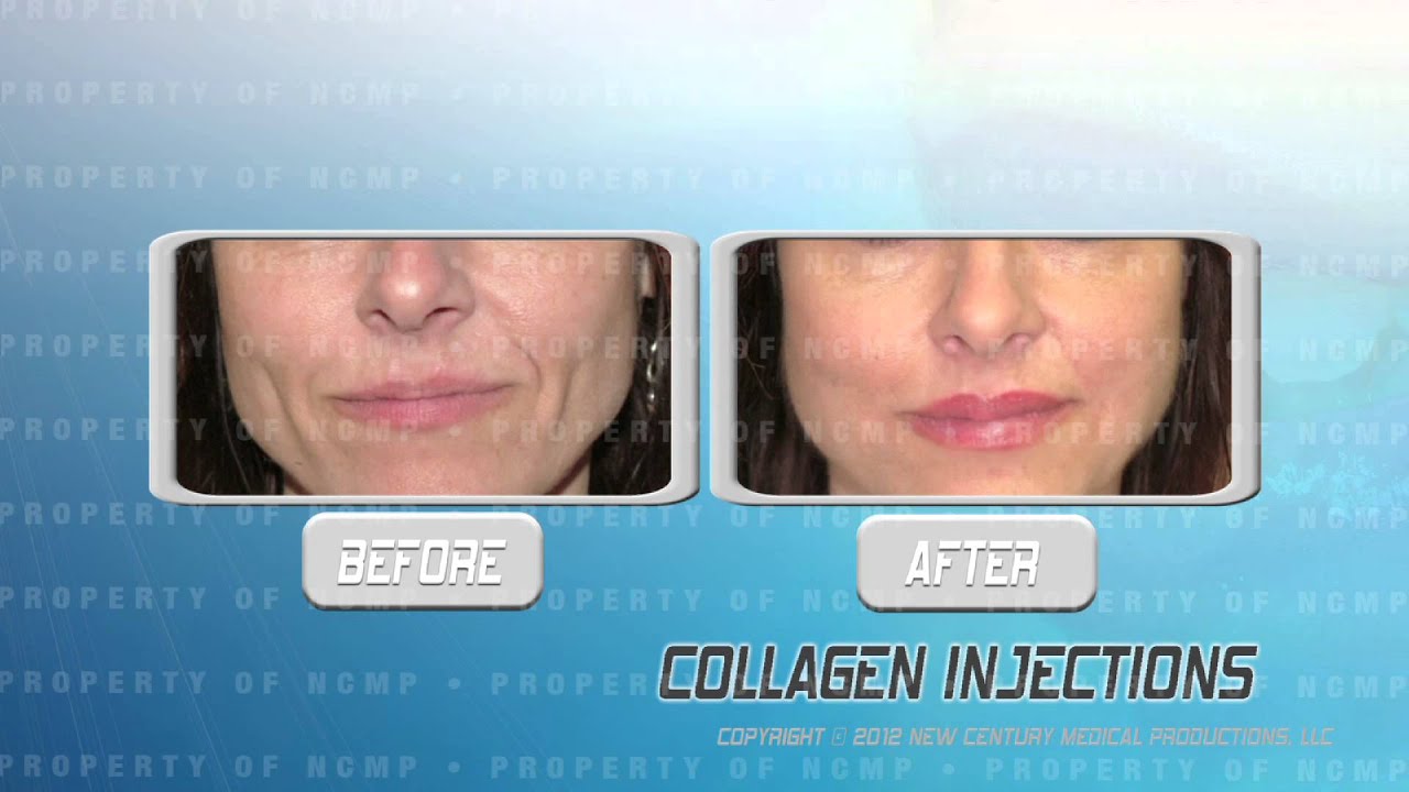 Collagen Injections - YouTube