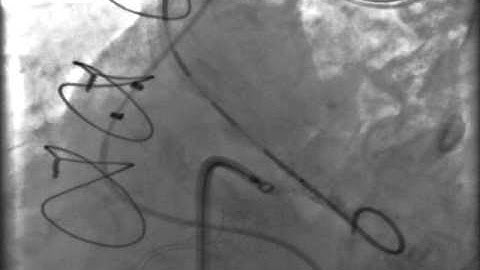 POST MYECTOMY  VSD CLOSURE WITH PMVSD DEVICE IN HYPERTROPHIC OBSTRUCTIVE CARDIOMYOPATHY