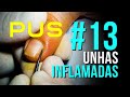 NOVA TEMPORADA SÉRIE (13) UNHAS INFLAMADAS (INFLAMED NAILS NEW SEASON - 13) - PODÓLOGO MAURÉLIO