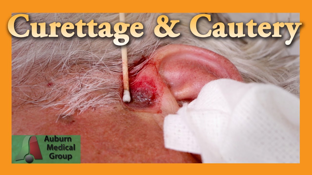 Curettage and Cautery for Basal Cell Carcinoma | Auburn Medical Group
