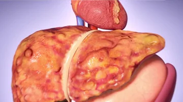 Quale di questi esami diagnostici è indicato in un paziente con ittero dolore addominale ed evidenza ecografica di dilatazione delle vie biliari?
