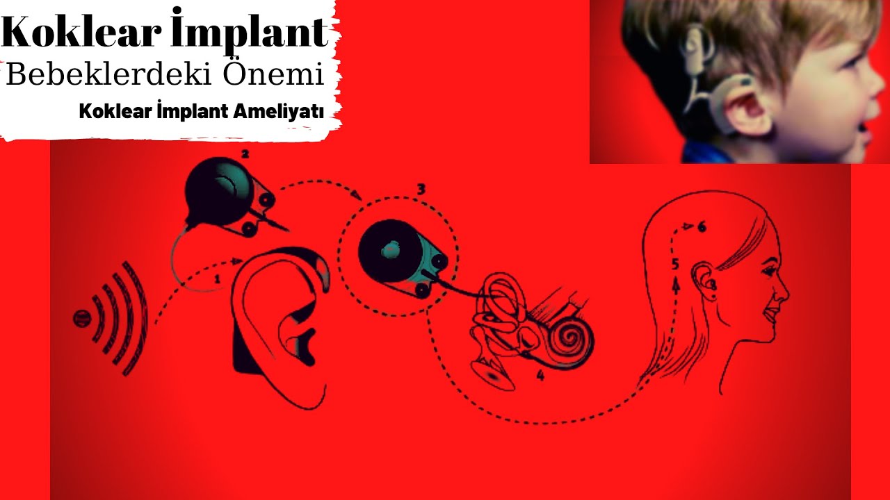 Koklear İmplant Nedir? Erken Teşhisin Önemi !!(Dil Ve Konuşma Bozuklukları Uzmanı Banu Ergünal Köse)