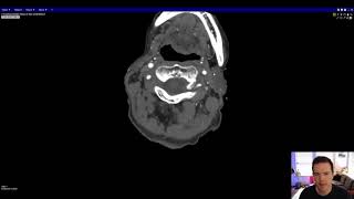 Vascular Imaging of the Head and Neck - Case A