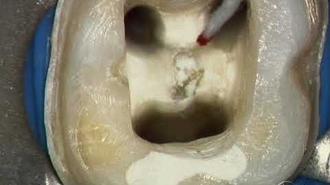 Vertical Condensation Technique - Mandibular Molar: Case I: Advanced Endodontics