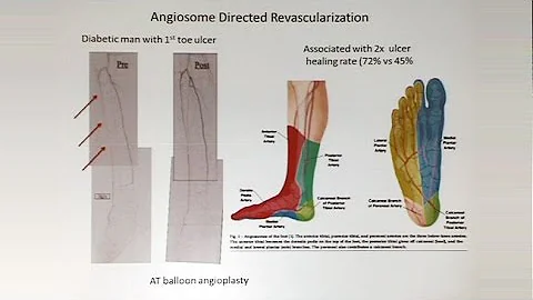 Staging the Neuroischemic Limb: Rutherford WIfI an...