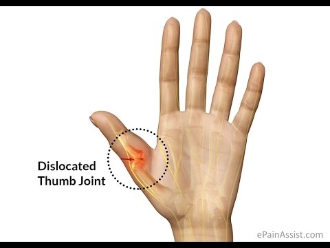 How I Dislocated My Thumb - YouTube