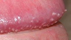 Hirsuties papillaris