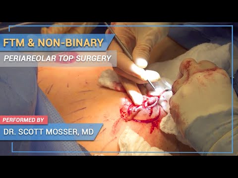 LIVE SURGERY of Transgender FTM/Non-Binary PERIAREOLAR Top Surgery Performed by Dr. Mosser