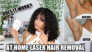 I Tried At Home Laser Hair Removal! | Does it work?? + DEMO