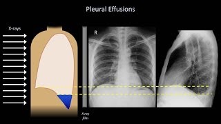 How to Interpret a Chest X-Ray (Lesson 6 - Diaphragm and Pleura)