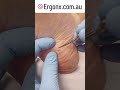 Goodbye Painful Heel Corn: Expert Removal by Australian Podiatrist #FootHealth #Podiatry