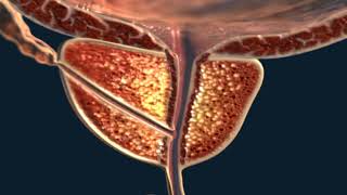 3D animation of prostate - in this example it is enlarged.
