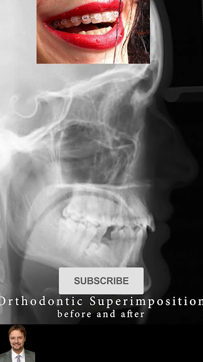 ❤️🔥 Orthodontic treatment Superimposition❗️