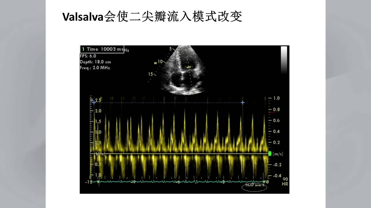 The Evaluation of LV Diastolic Function by Echocardiography Webinar - YouTube
