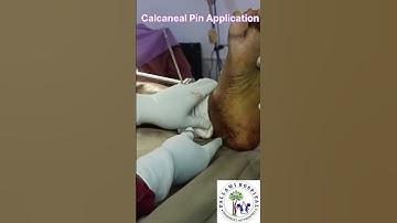 Ankle Spanning External Fixation #mancherial #orthopaedicsurgeon #viral #viralvideo #viralreels