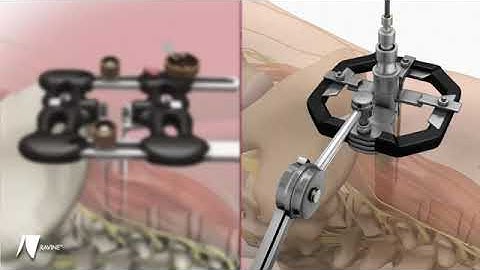 Stryker (K2M):RAVINE Muscle Splitting Technique