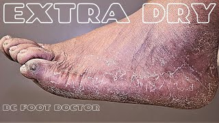 Extra Dry: Calluses, Dry Skin, Athlete's Feet, and Exfoliation