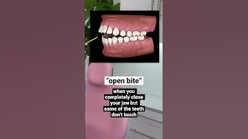 do you have an open bite? #shorts
