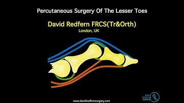 International Webinar Minimally Invasive (Percutaneous) Lesser Toe Surgery