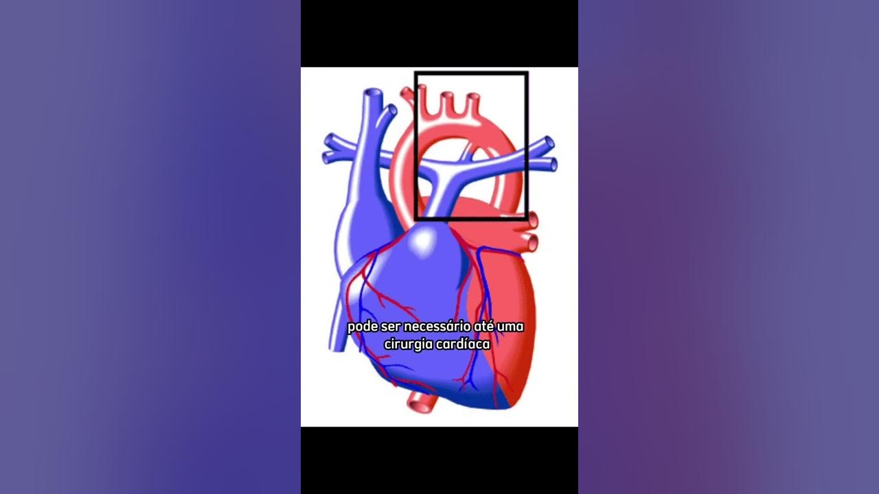 Persistência do Canal Arterial (para leigos) PCA YouTube
