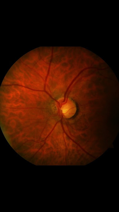 Are features associated with tilted optic disc something, they also develop in an adult eye?