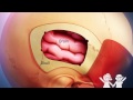 Sam's Journey with Epilepsy Surgery