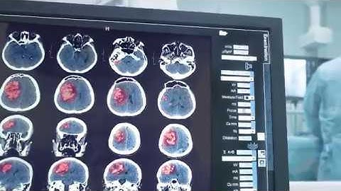 “Brain on Fire” Condition Explained: What is Anti-NMDA Receptor Encephalitis?