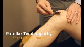 Graston Technique  Patellar Tendinopathy