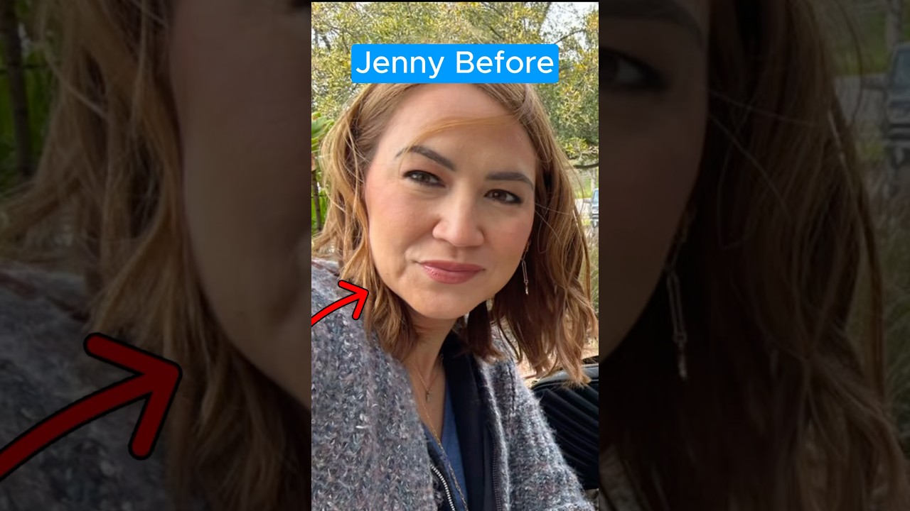 1 Year Facelift Interview (Young 40s Jowls)