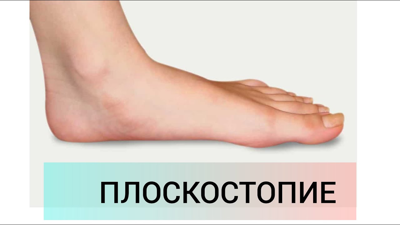 ПЛОСКОСТОПИЕ/ПРИЧИНЫ ДИАГНОСТИКА И ЛЕЧЕНИЕ - YouTube