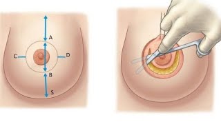 Donut Breast Lift Before And After