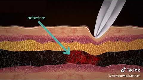 Sweet Sweat: gel massage trị liệu IASTM số 1 của Mỹ
