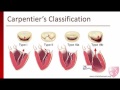 Mitral Regurgitation