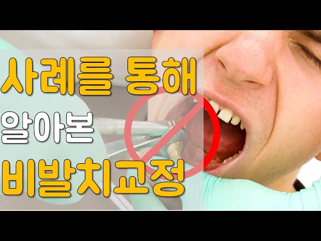 [비발치교정]사례를 통해 알아보는 비발치교정