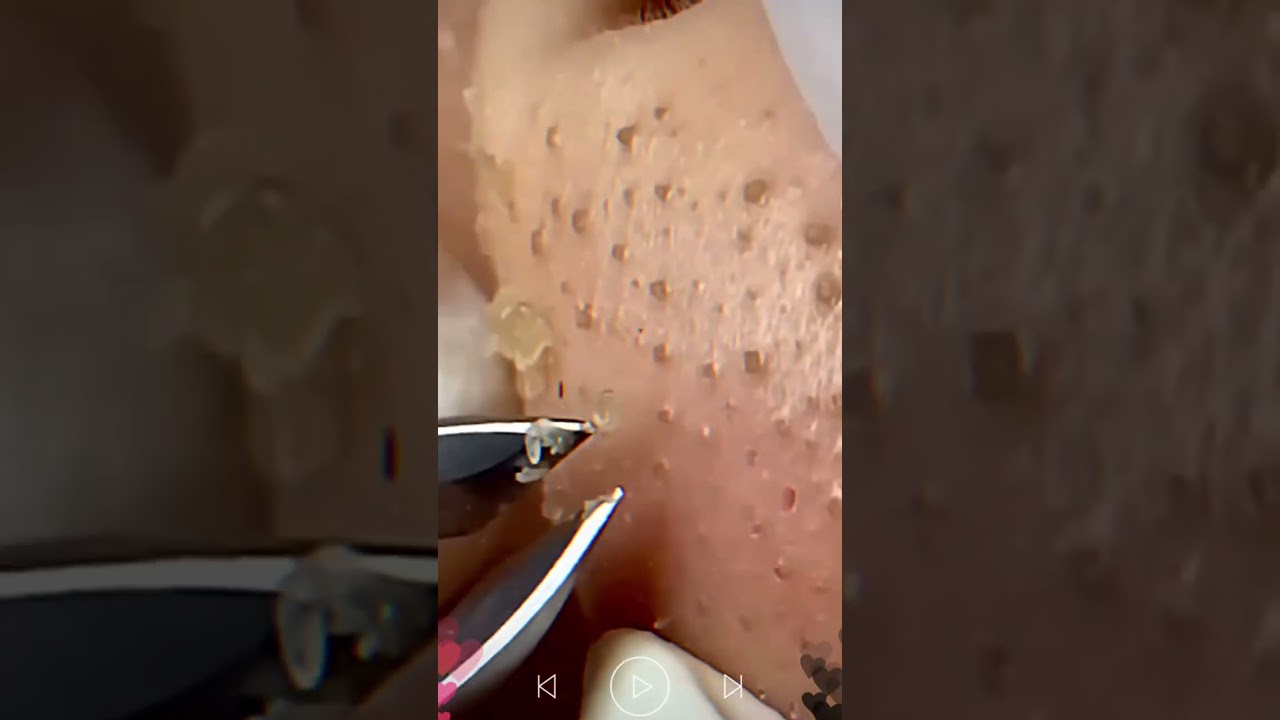 Skincare | Blackheads Removal #239 #tweezers skincare #blackheads blackheads