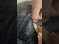 #fypviralシ #statisfying #lice #hair #LiceOnHead #liceremoval  #brasil #xyzbcafyp #licecomb  #kutu