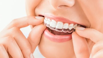 Invisalign introduction