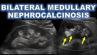 Medullary Nephrocalcinosis On Ultrasound