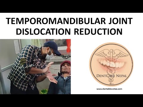 Reduction of Temporomandibular joint Dislocation @DentCareNepal