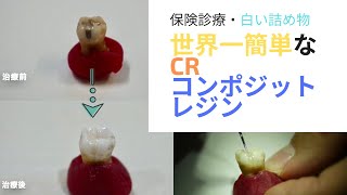 世界一簡単なCR（コンポジット・レジン修復）で歯の形を作る方法・保険診療・高解像
