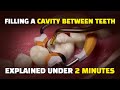 Filling a Cavity between Teeth: Class II Composite Resin Procedure to treat an interproximal cavity