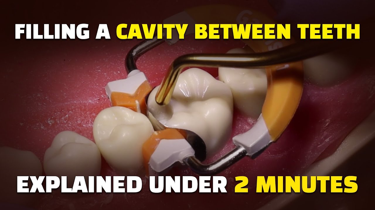 Filling A Cavity Between Teeth: Class Ii Composite Resin Procedure To Treat An Interproximal Cavity