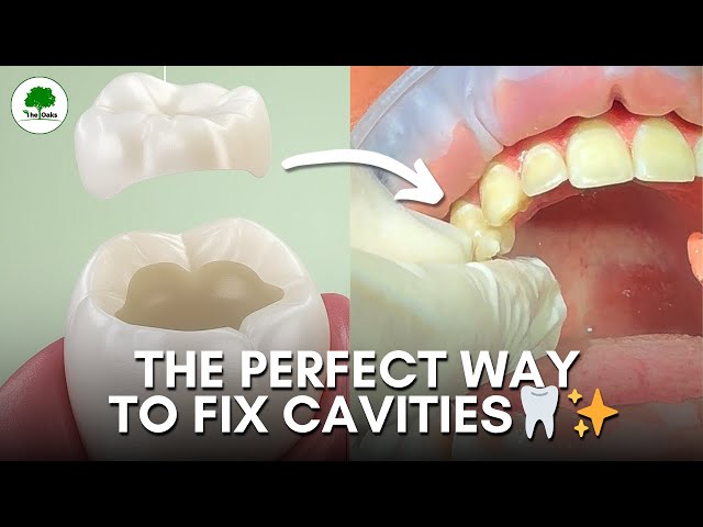 Joshua’s Onlay Filling Treatment | Oaks Dental Clinic