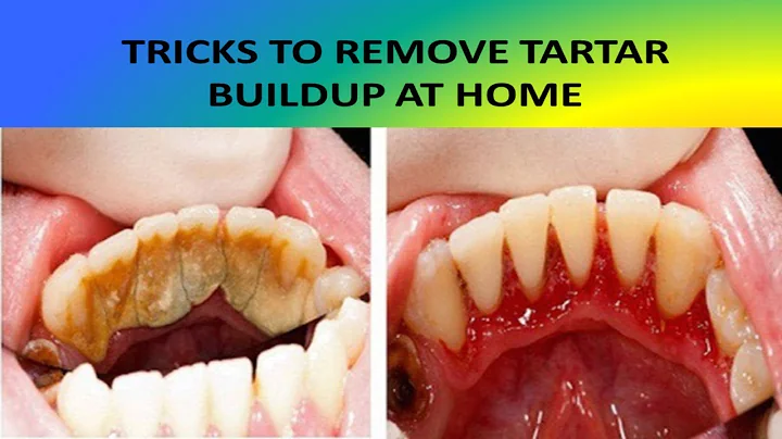 How To Remove Stains and Plaque From Teeth To Help...