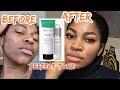 HOW TO CURE ACNE W.PERFEC-TONE|*6 MONTHS UPDATE* #FADEDSCARS + CLEAR SKIN. #ACNE#HYPERPIGMENTATION