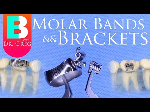Braces Bands vs Brackets for Molars in Orthodontics