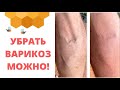 Варикозная болезнь причины и решения | Николай Мавричев